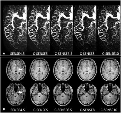 Acceleration of pCASL-Based Cerebral 4D MR Angiography Using Compressed SENSE: A Comparison With SENSE